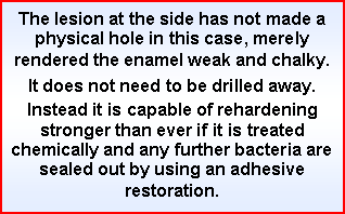 Text Box: The lesion at the side has not made a physical hole in this case, merely rendered the enamel weak and chalky. 
It does not need to be drilled away. 
Instead it is capable of rehardening stronger than ever if it is treated chemically and any further bacteria are sealed out by using an adhesive restoration.
